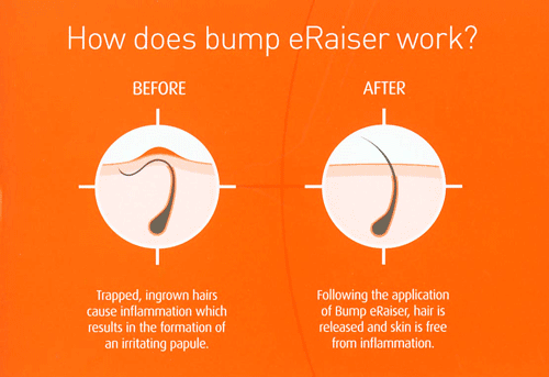 Ingrown_hair_treatment